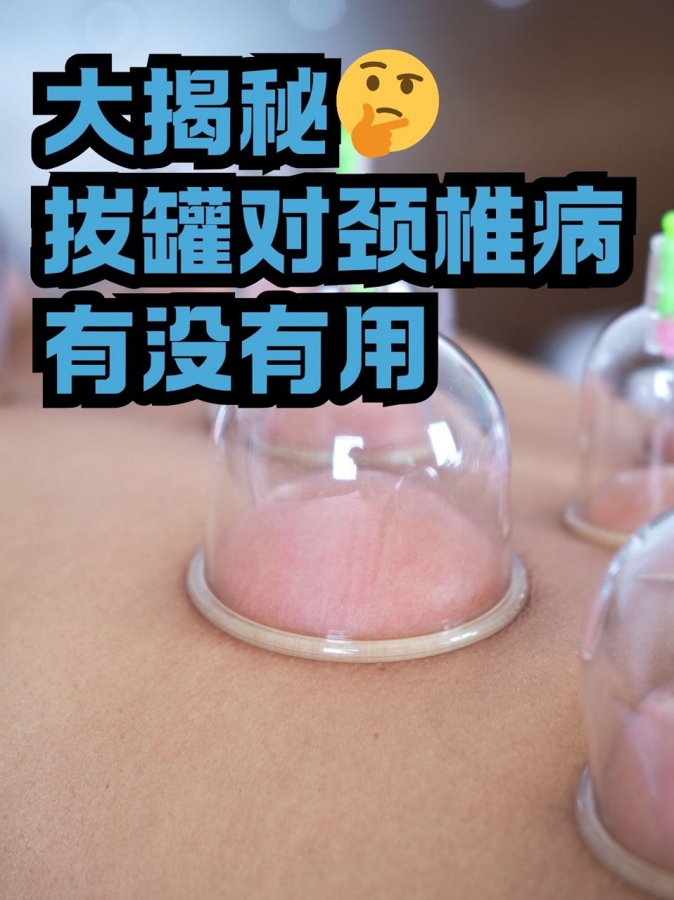 大揭秘04拔罐对颈椎病有没有用 长期的低头工作,过度劳累,往往会使