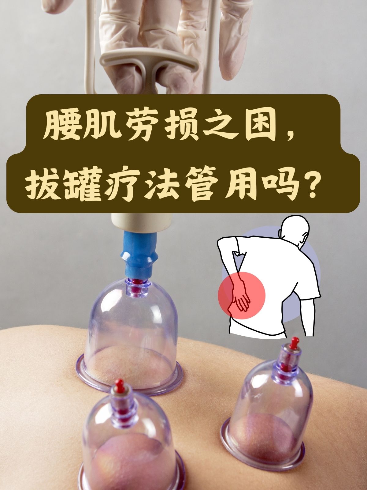 腰部拔罐的正确位置图图片