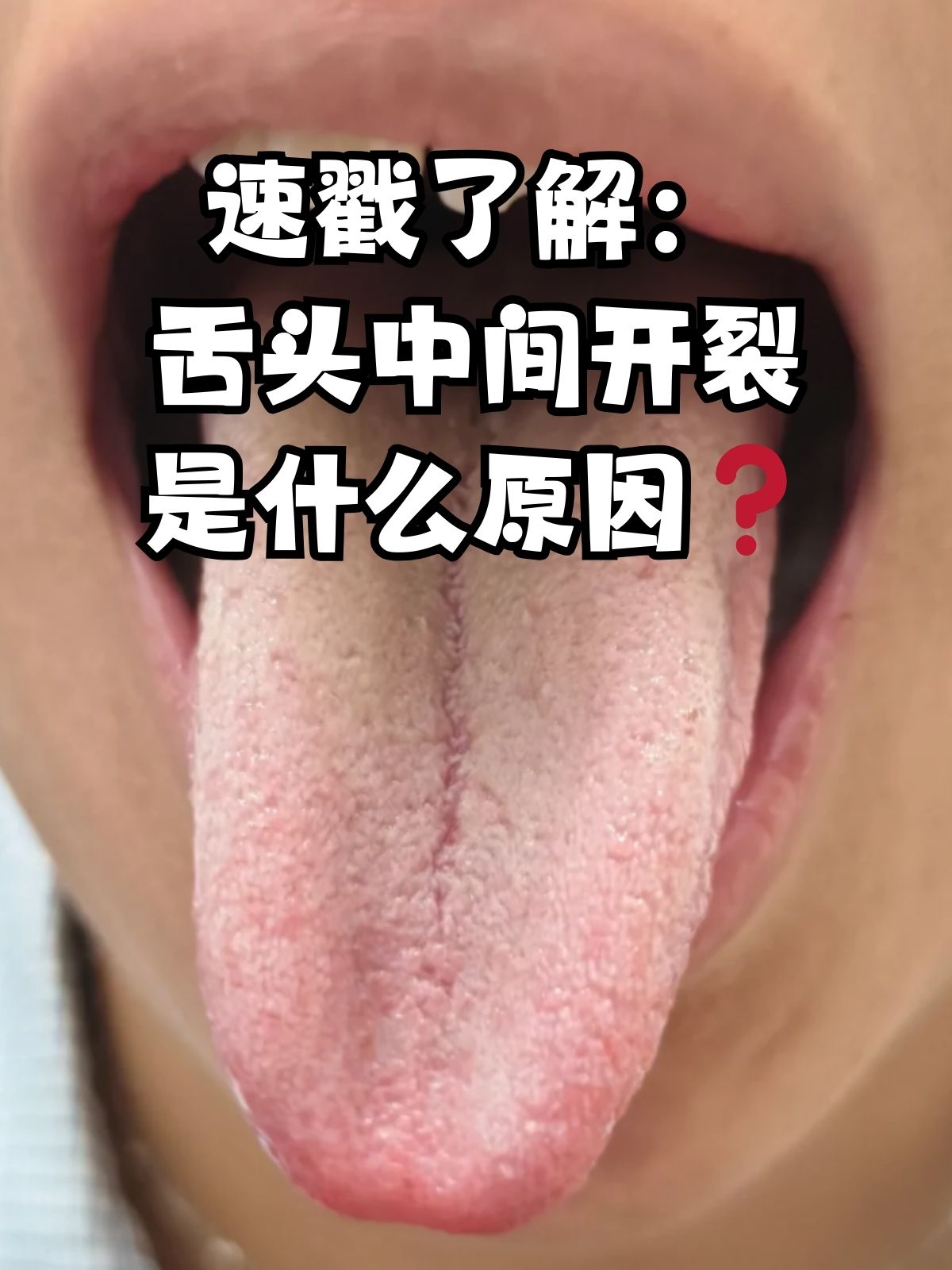 为什么舌头发麻 为什么舌头发麻