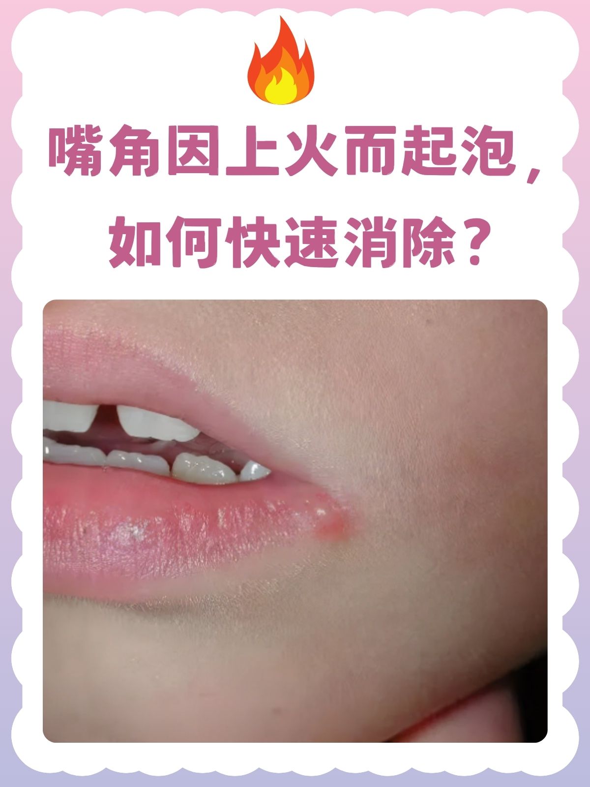 想快速消除上火起的嘴泡,要内外结合处理