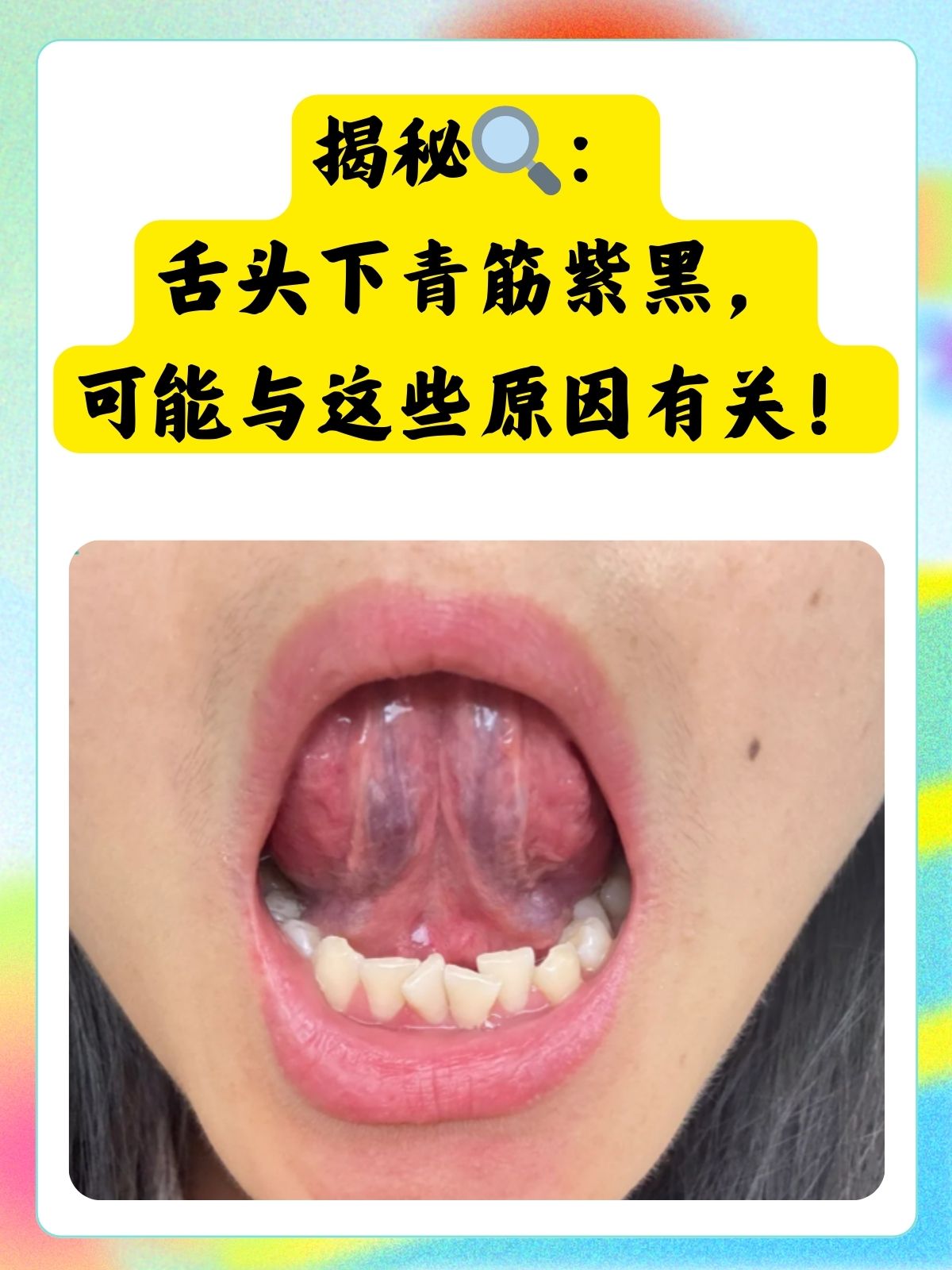 这不仅仅是舌下的一个"小异常",在中医的世界里,它可能是身体向我们