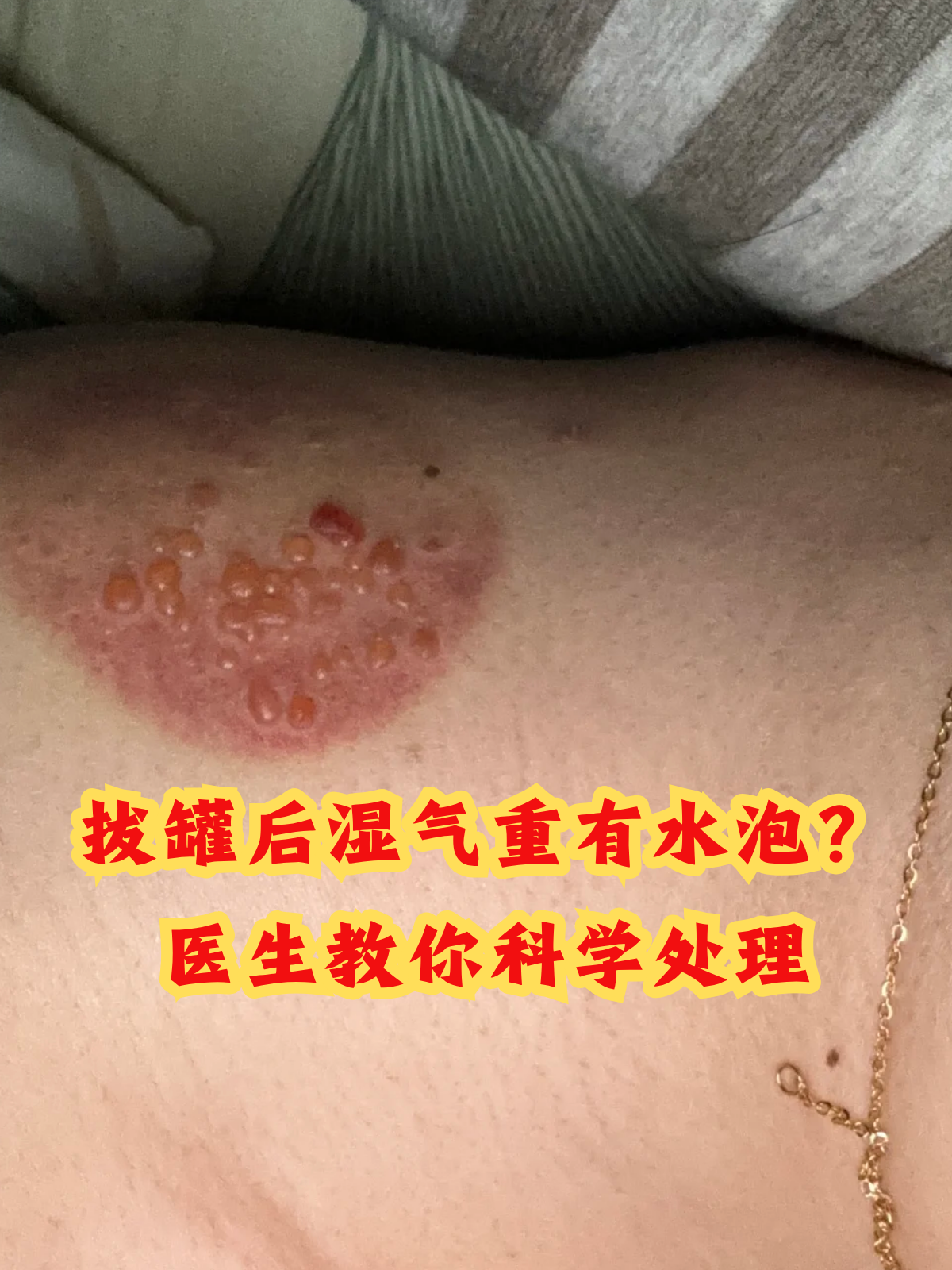拔罐后湿气重有水泡?