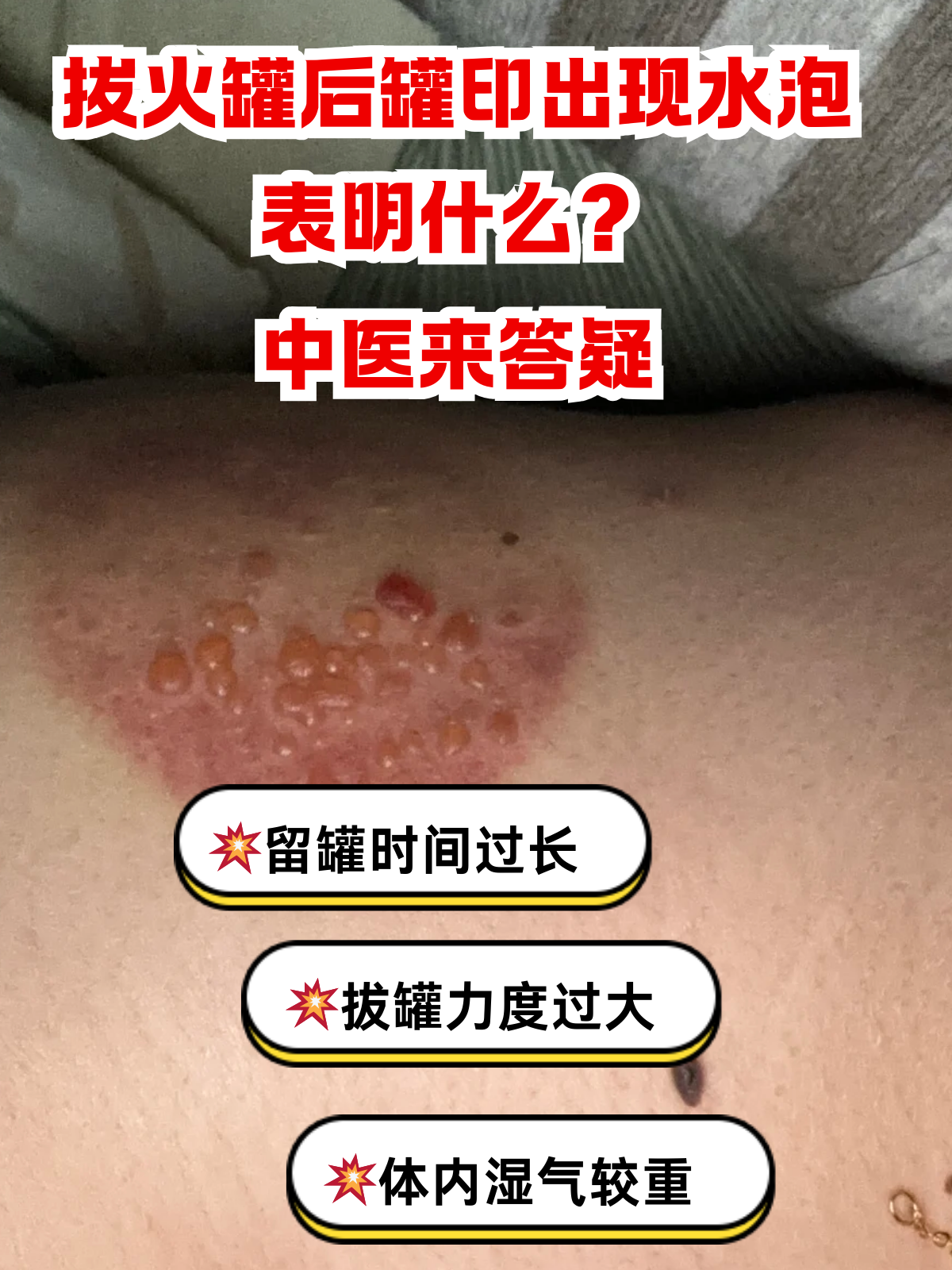 拔火罐后罐印出现水泡表明什么?