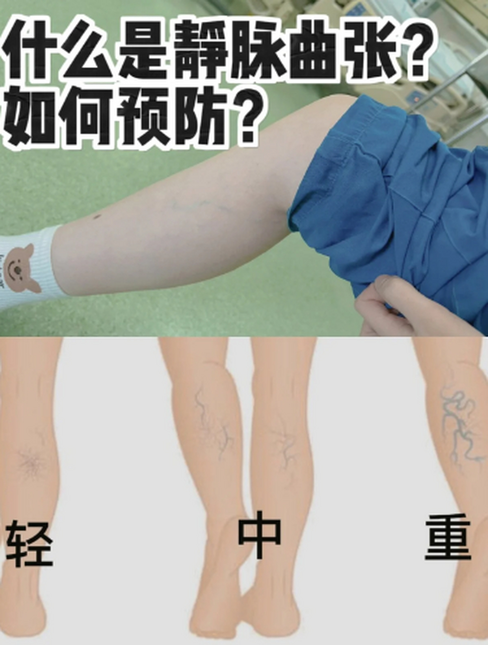 🏥如何判断自己患有静脉曲张❓ ‼症状主要表现: 1.