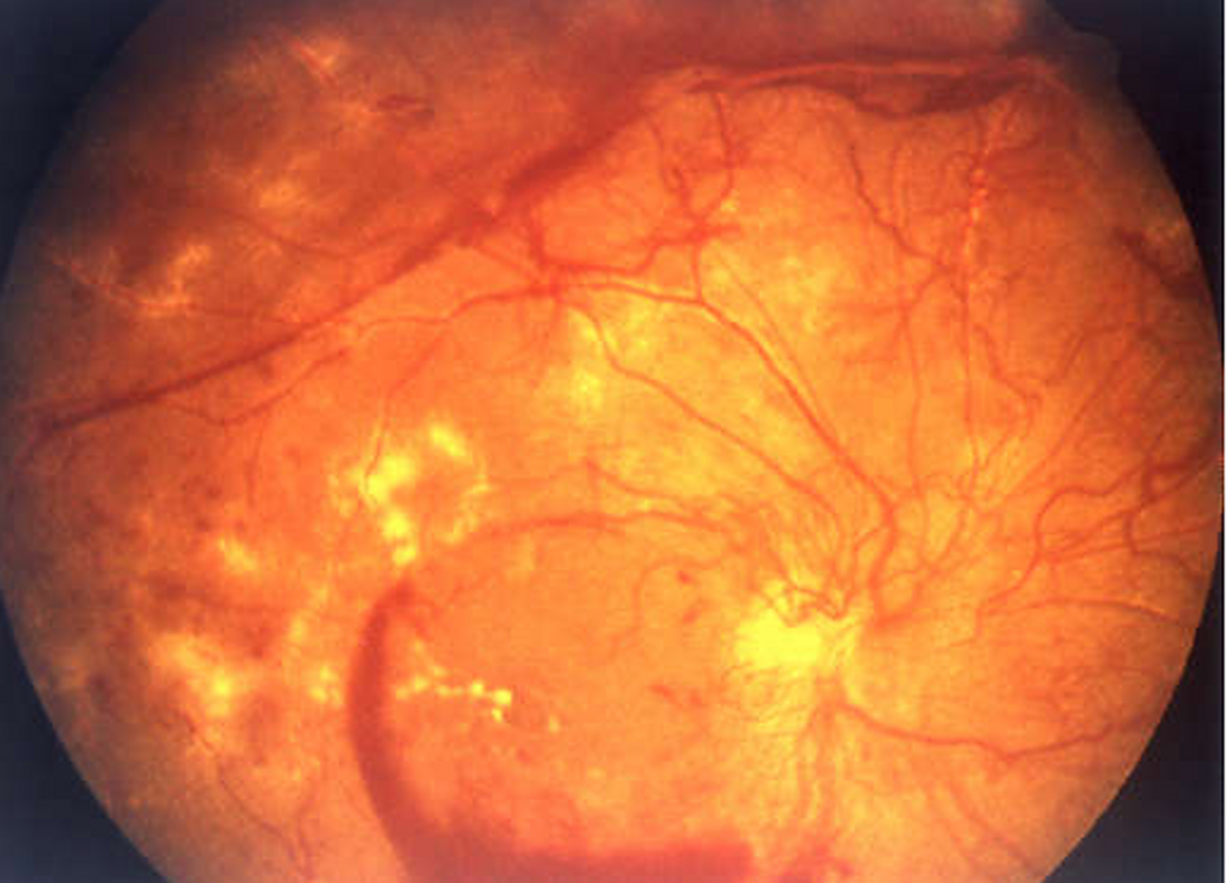 糖尿病眼底病变不想手术可以吗?