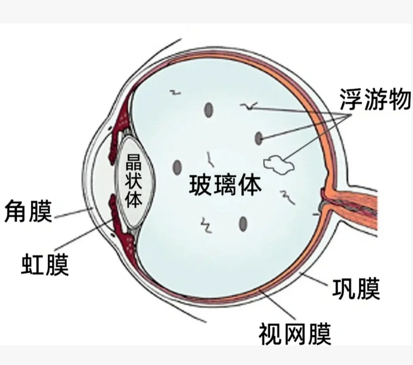 玻璃体星状变性描述图片