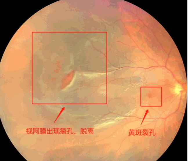 什么是视 视网膜脱离视网膜脱离的眼底图片视网膜脱落视网膜脱落图片