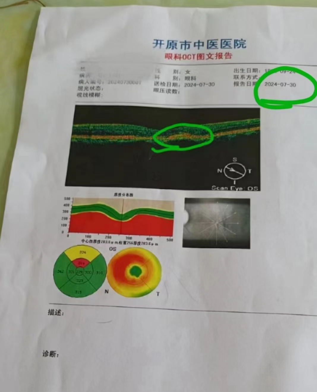 20岁脉络膜新生血管图片