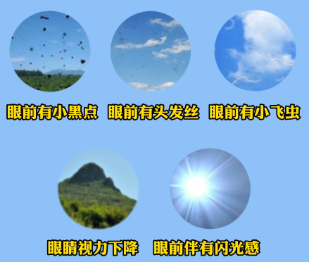 简单一味中成药,改善飞蚊症