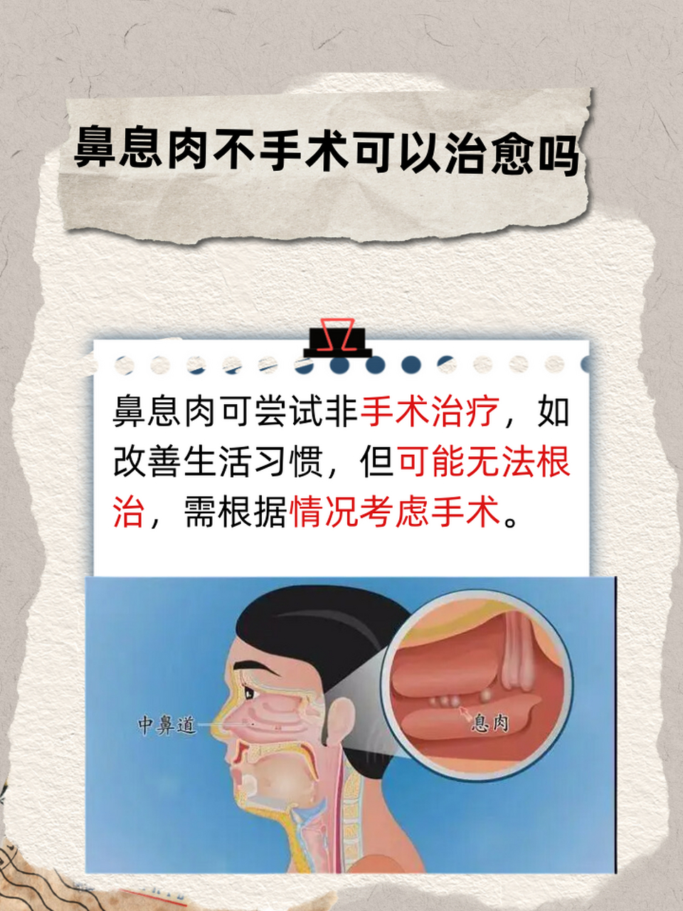 事实上,鼻息肉的治疗并非只有手术一条路.