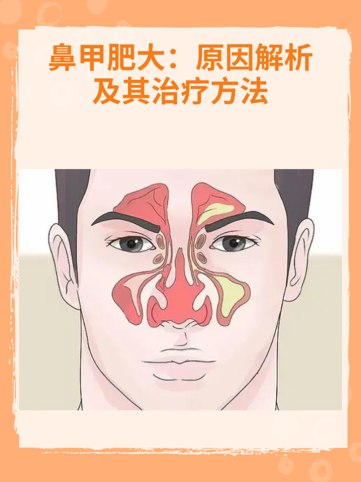 👉鼻甲肥大:原因解析及其治.@耳鼻喉刘翔医生的动态