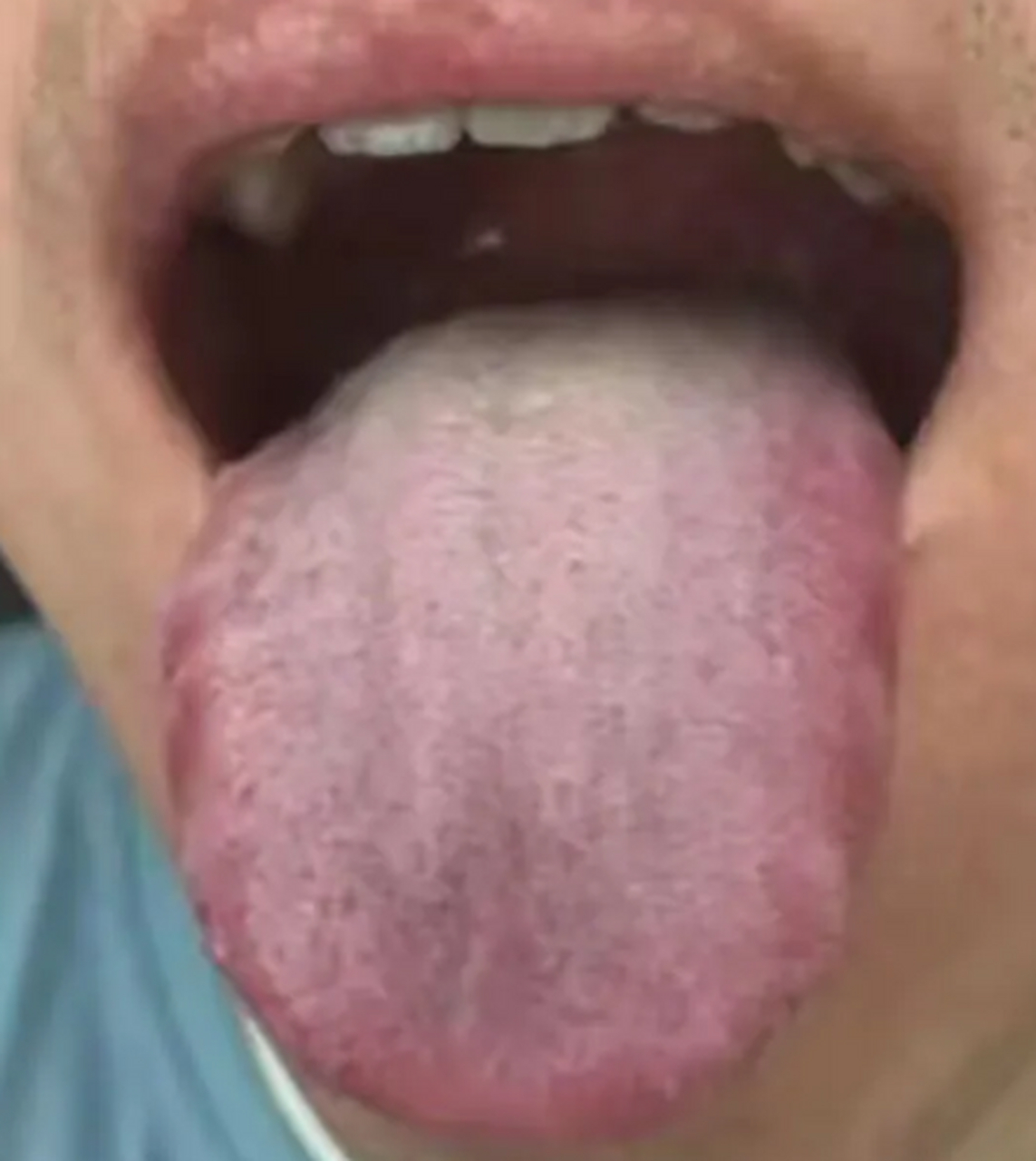 腹胀,口苦,口臭,其实情况都写在舌头上了,这种舌头不要盲目进补  症状