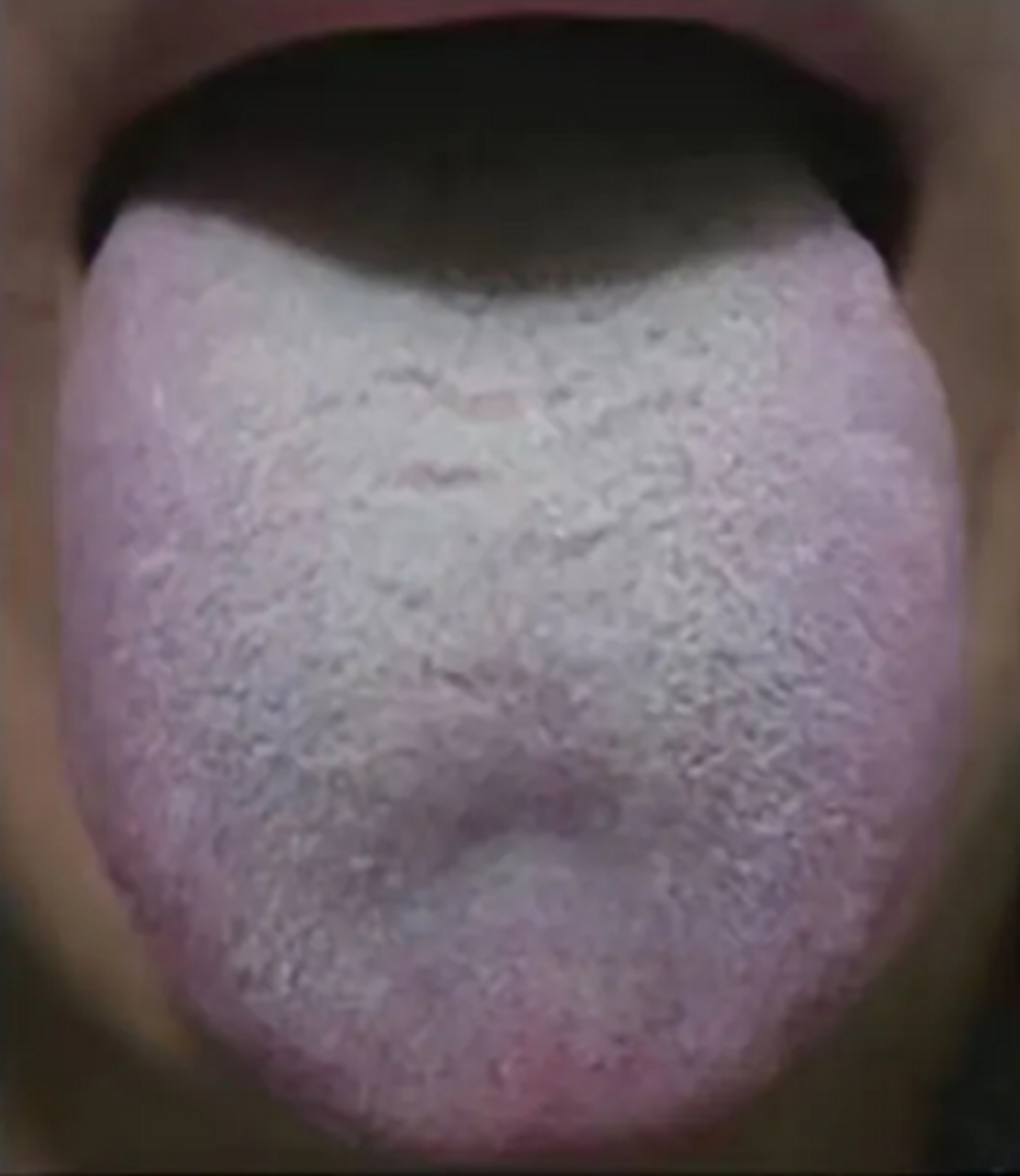 症状: 这是一位36岁男性的舌象,他说自己是血瘀体质,用过很多活血