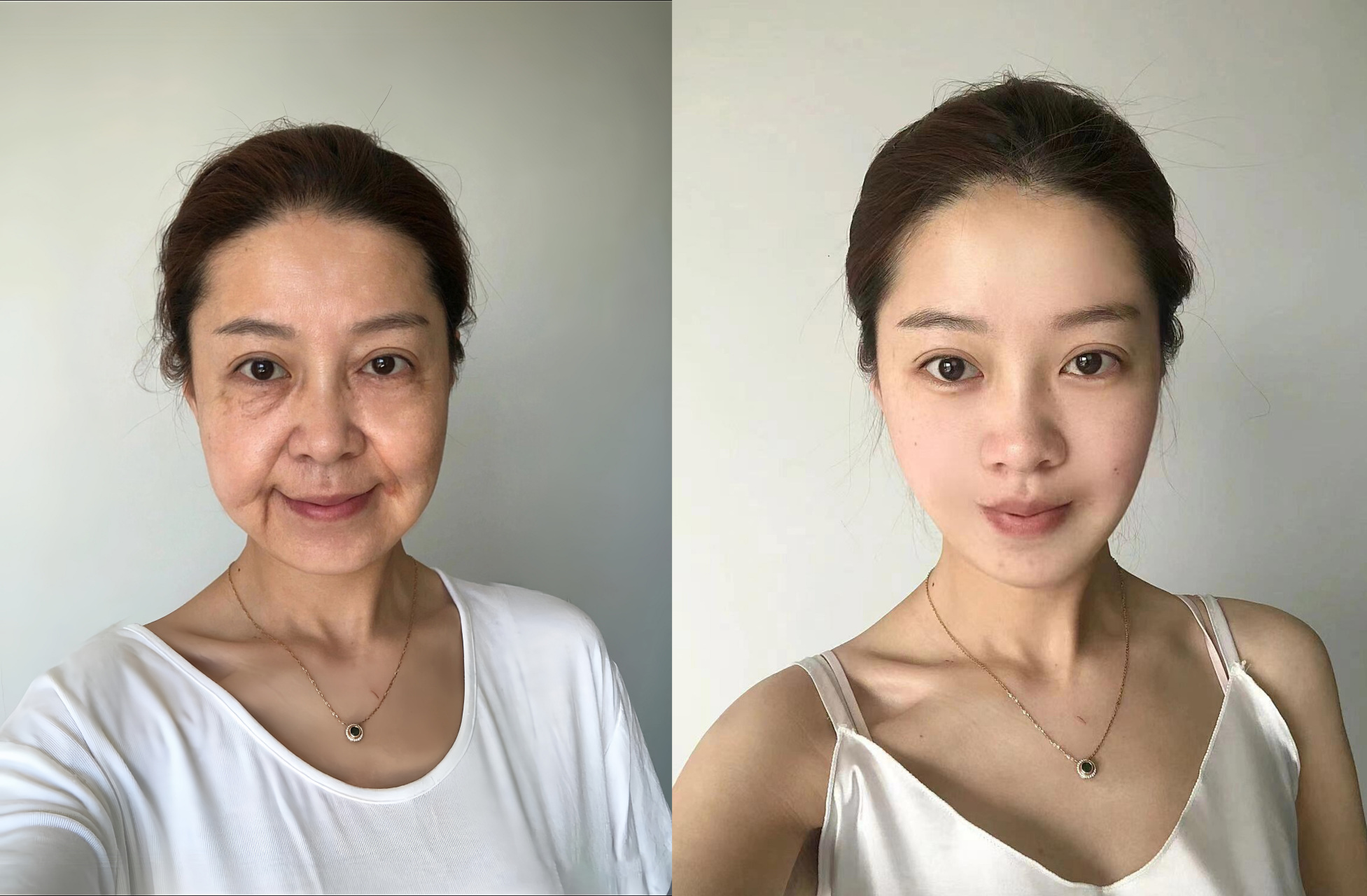 之前由于做了黑医美填了奥美定,还填了脂肪,又做了十次线雕,结果