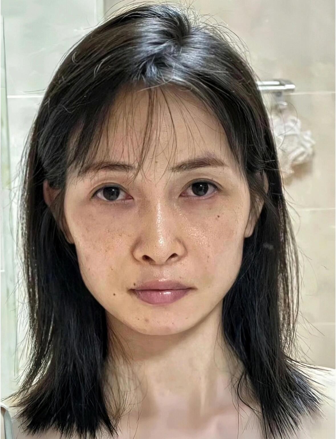 不顾反对做了提升,才知道,现在医美都被妖魔化了