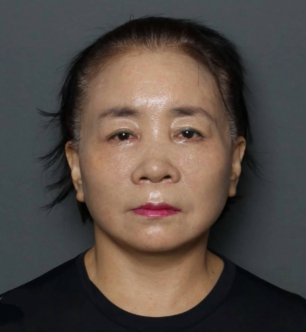 67岁阿姨不顾劝阻做完拉皮,第十天被自己丑哭,结果