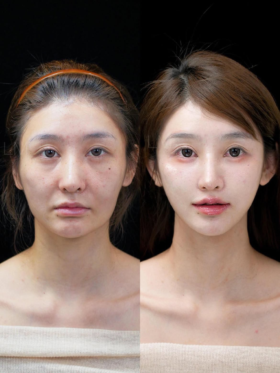 今年39岁,我一直想做点什么来改变自己面部松弛的问题