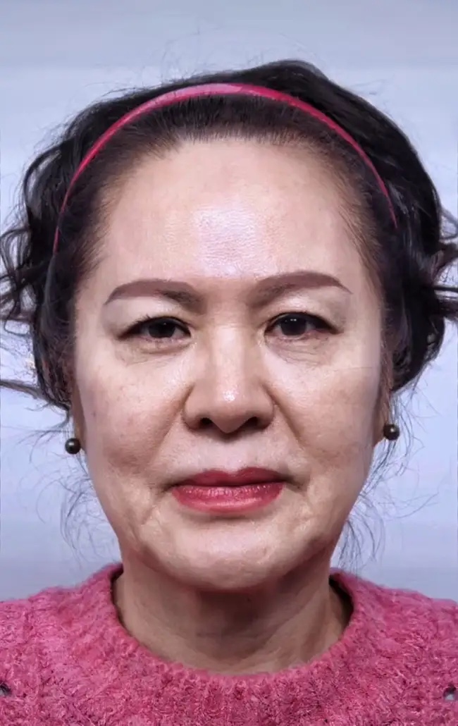 女人的脸容量缺失导致面部衰老不老面相60岁法令纹脸皮下垂发际线后移