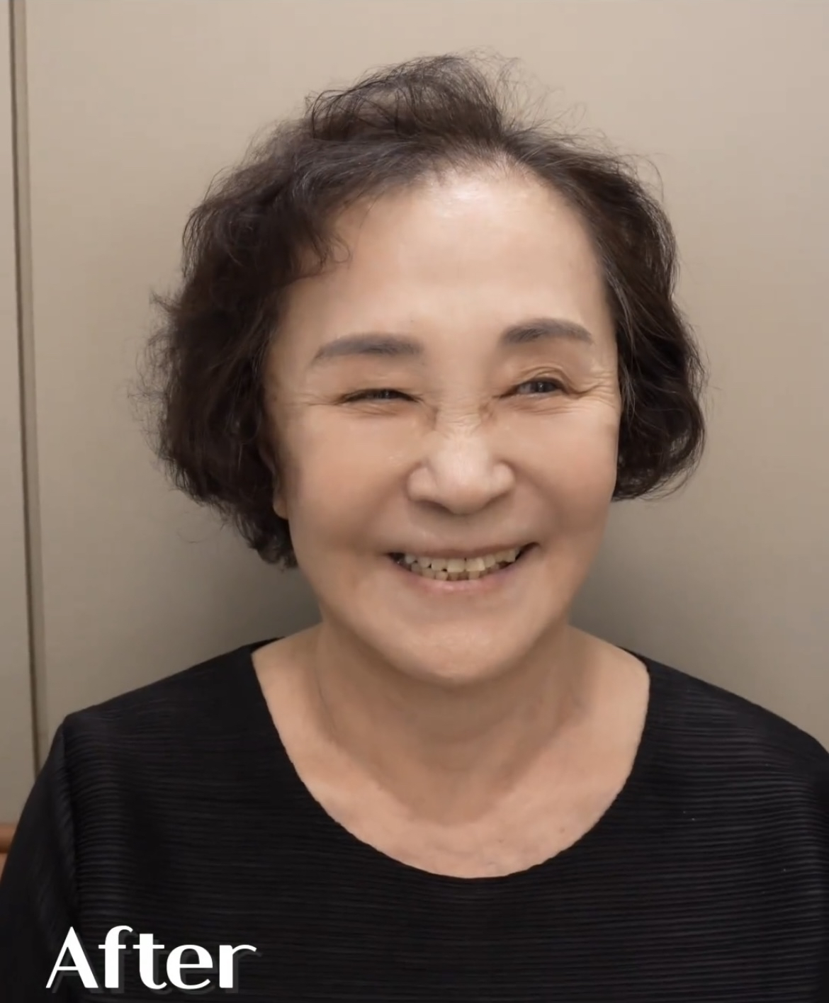 儿子花了5w带我去做医美变年轻,术后30天儿媳知道