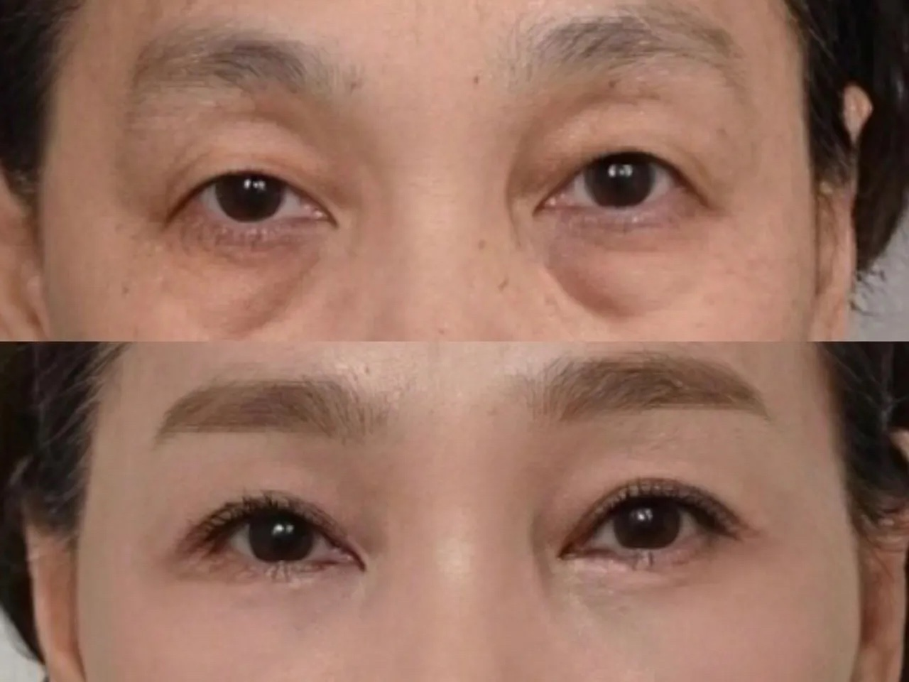 现在的求美者都很聪明,都知道选择,小切口,低创伤