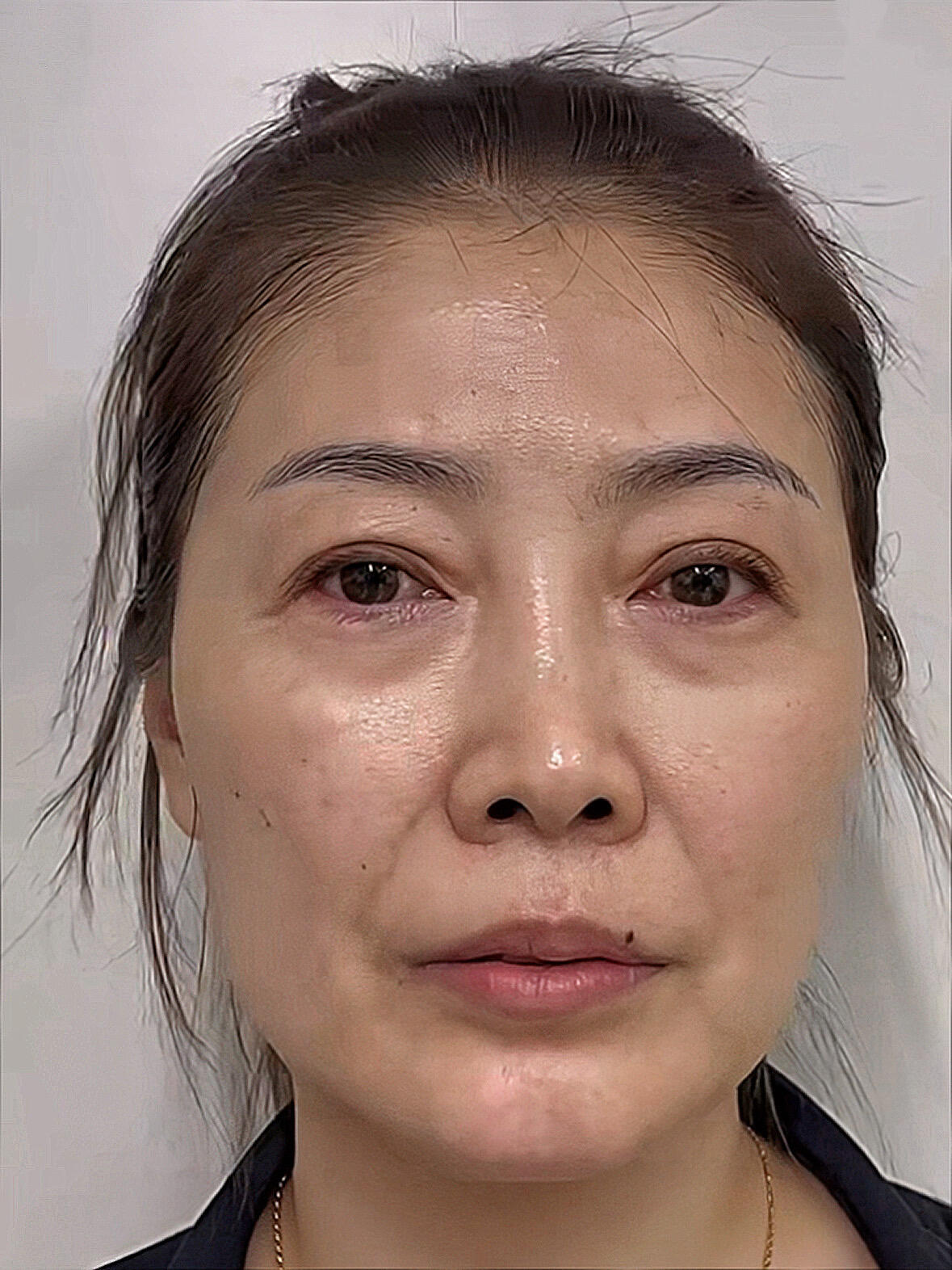 于是就做了眼周筋膜提升去除眼袋的同时还能做个卧蚕还能把下垂的