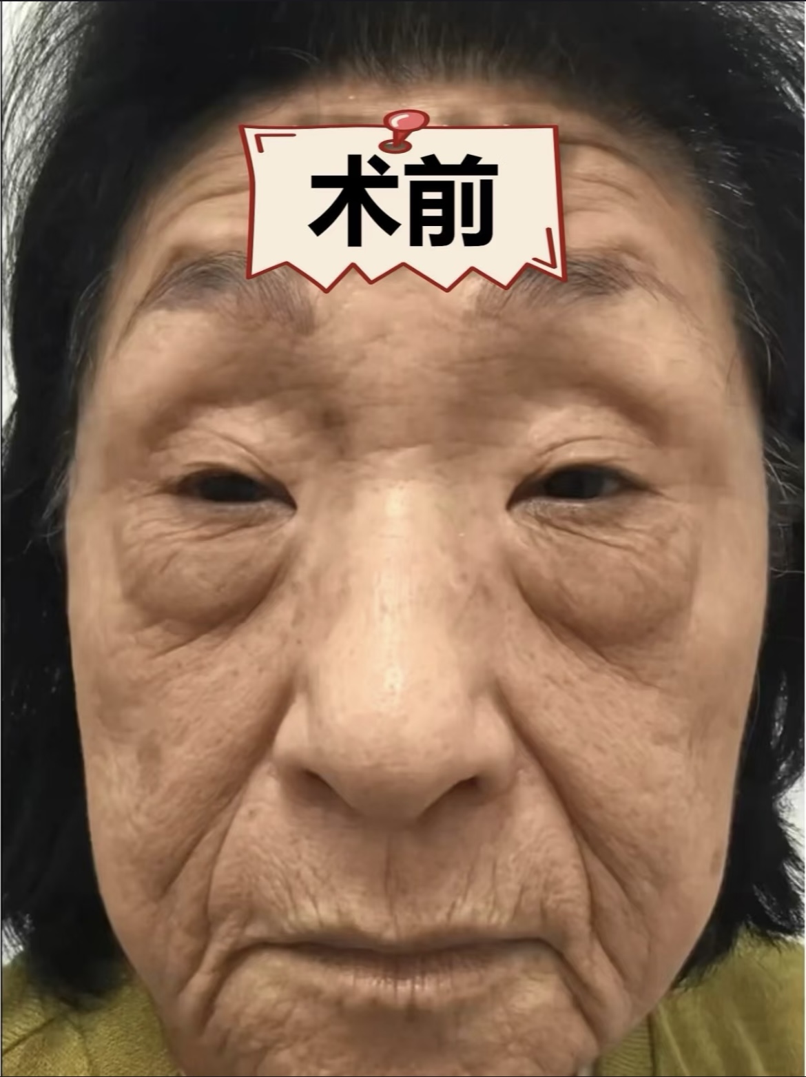 项目眼周筋膜提升+下面部无痕筋膜提升 操作成都杨迪主任 改善