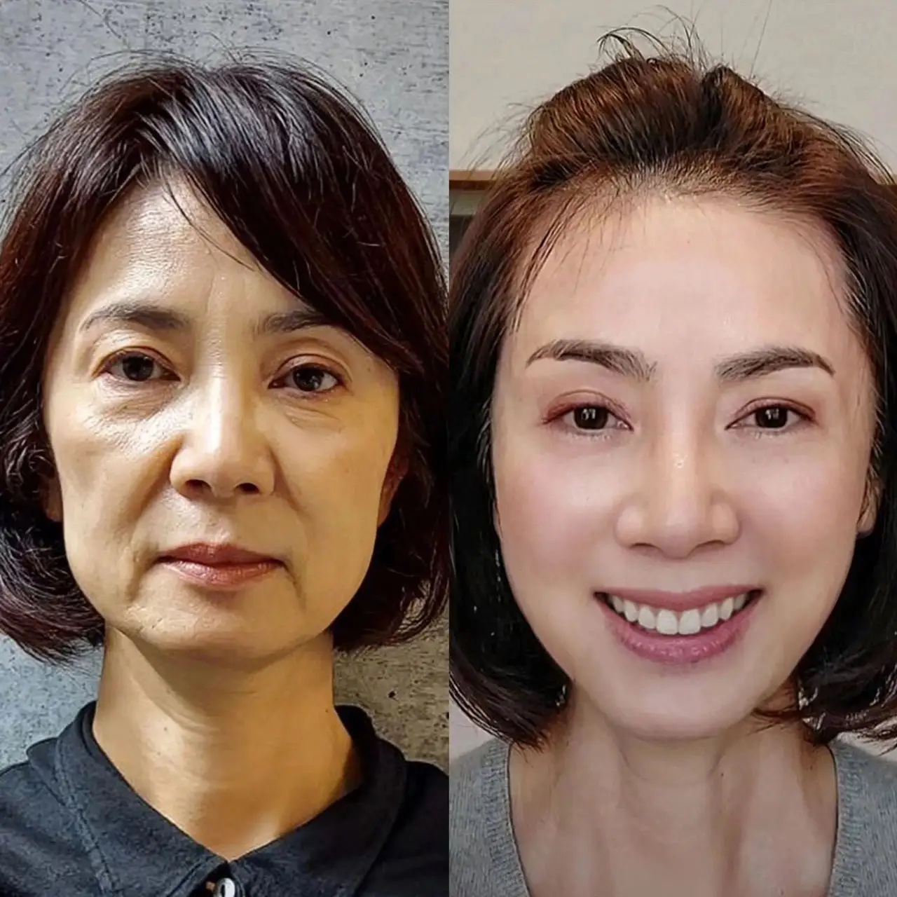 我做了个眼周筋膜提升,效果真的不错!