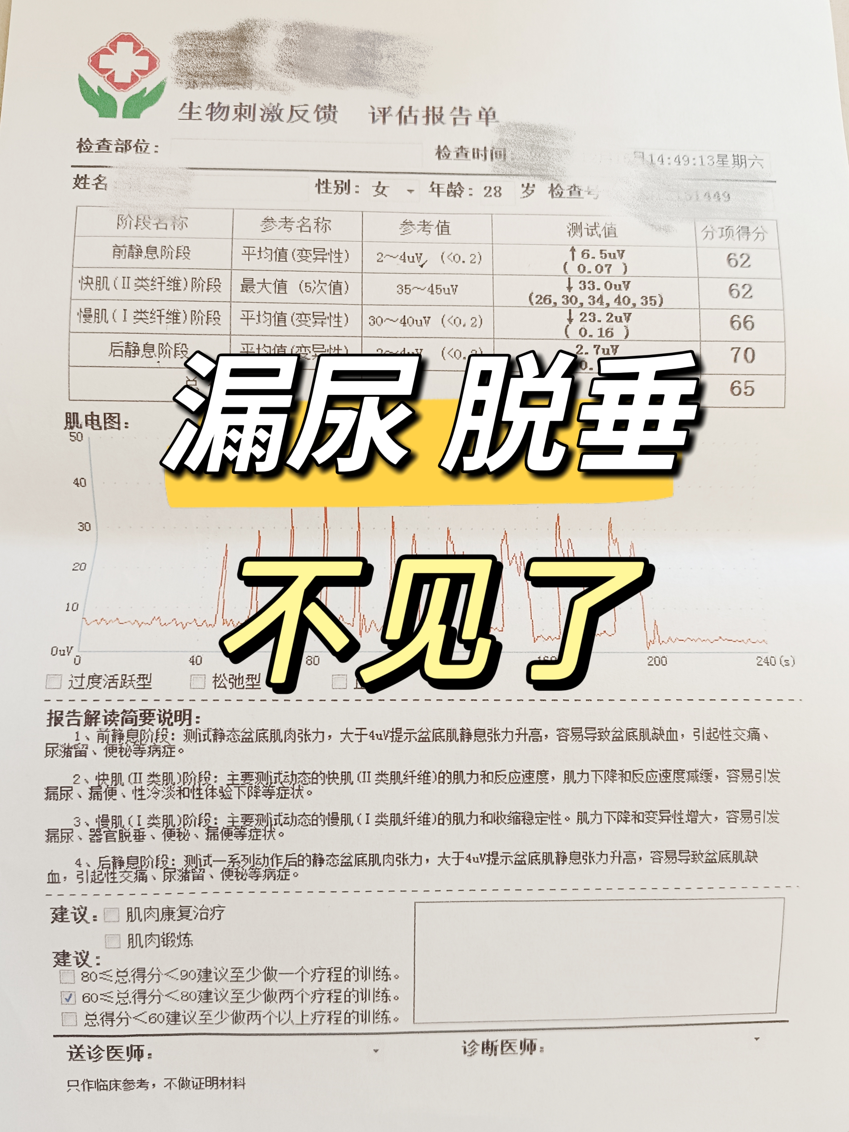 脱垂,她自己能摸到一个"肉球",这一年多的时间,每次咳嗽大笑都会漏尿