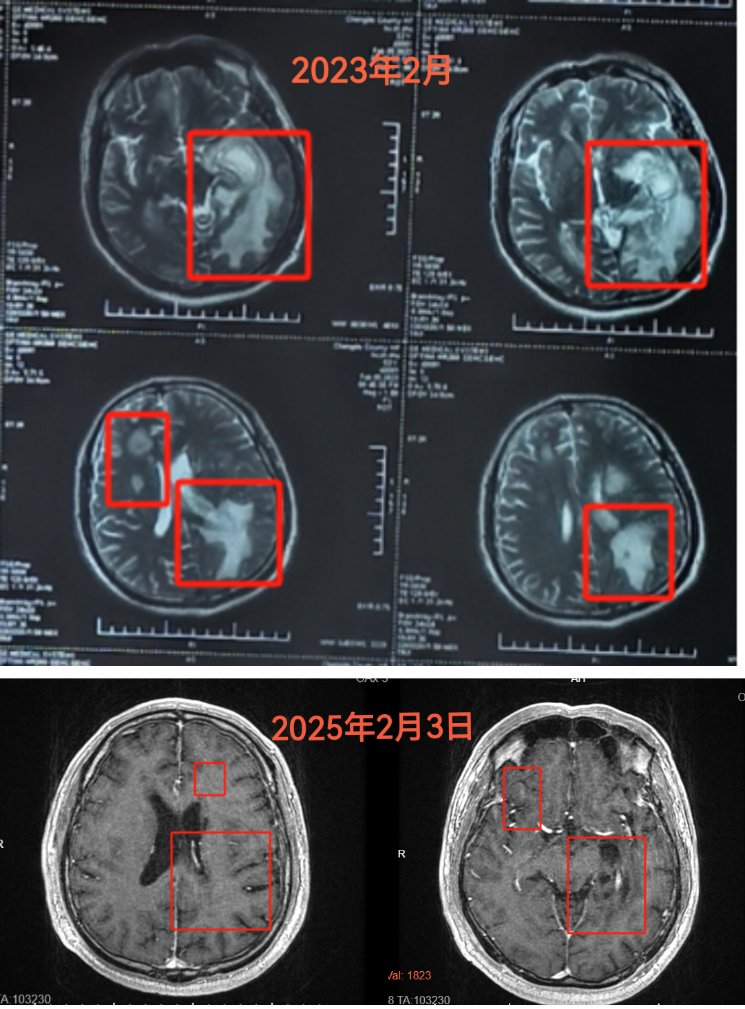 54岁,河北人,颅内多发脑转移瘤,没有找到本源瘤,2023年2月14日做核磁