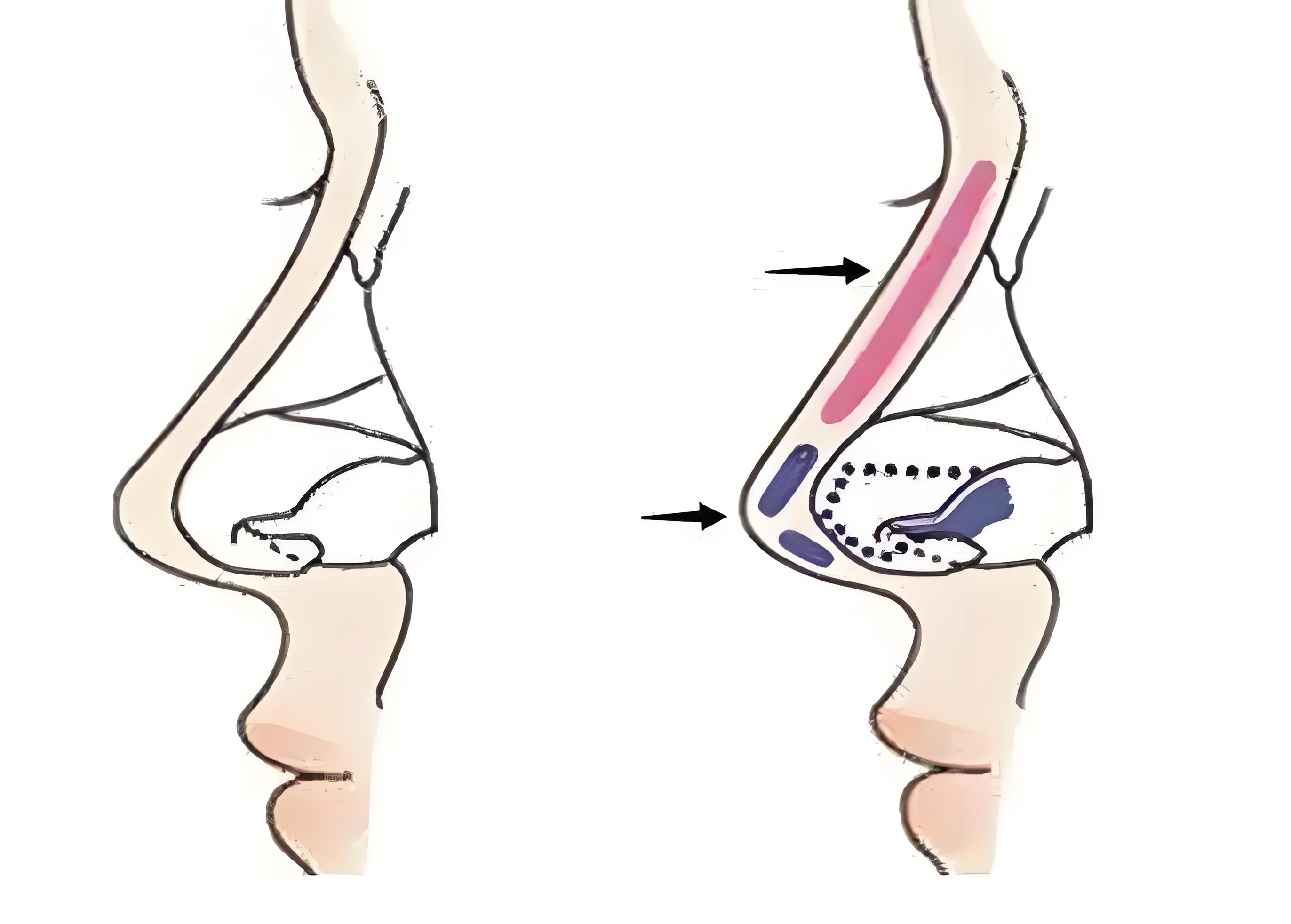 鼻子假体取出后,确实会出现肿胀的情况