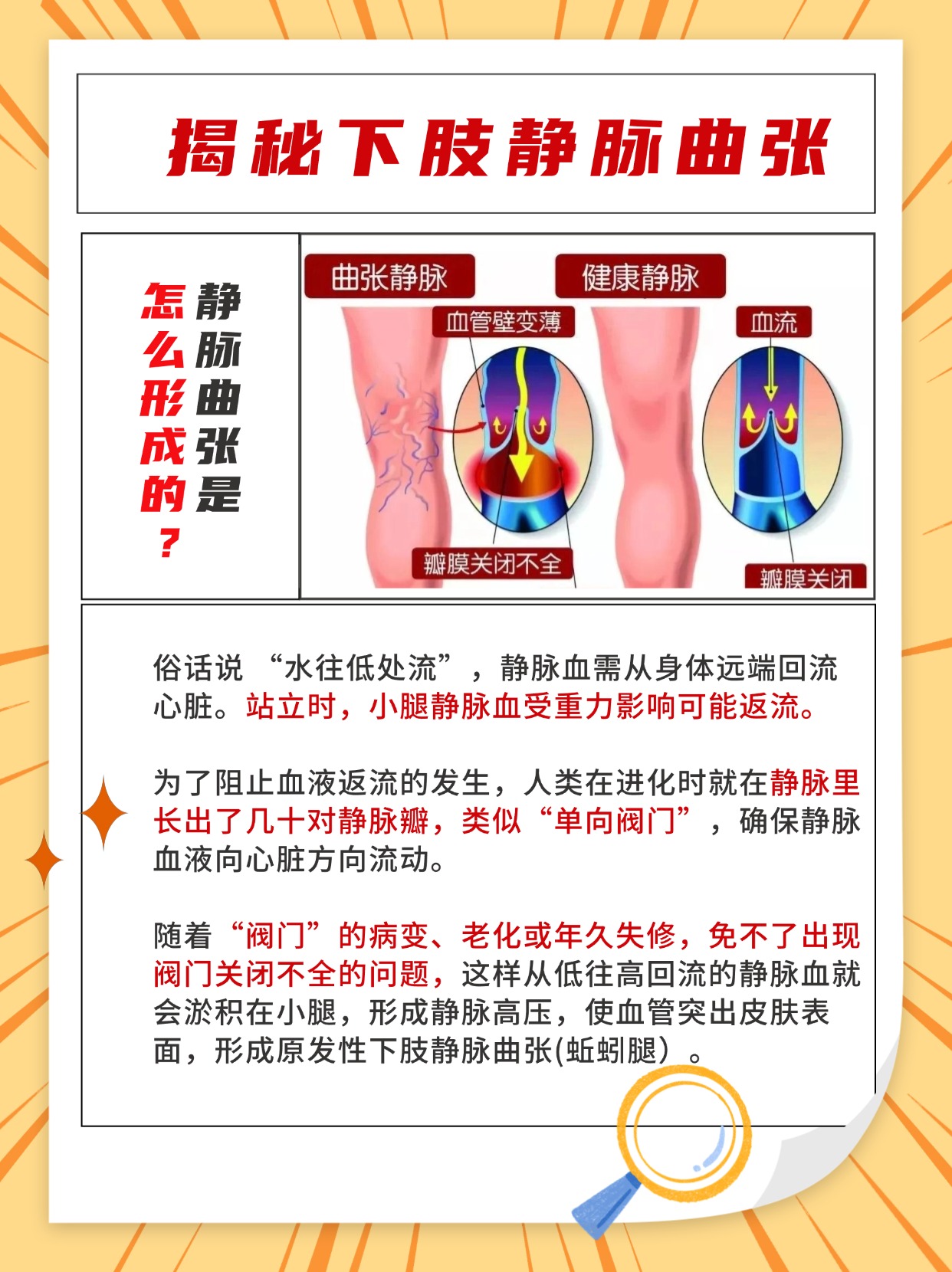 腿上的静脉曲张是怎么形成的?