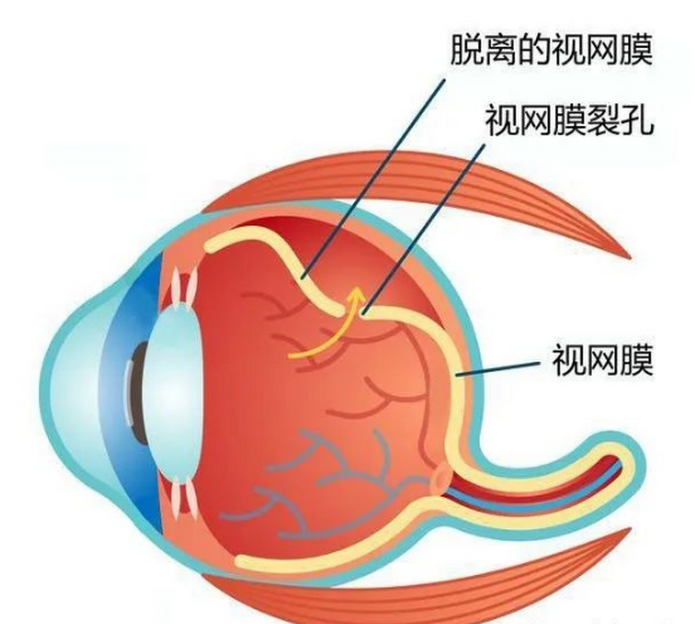 视网膜脱落照片图片