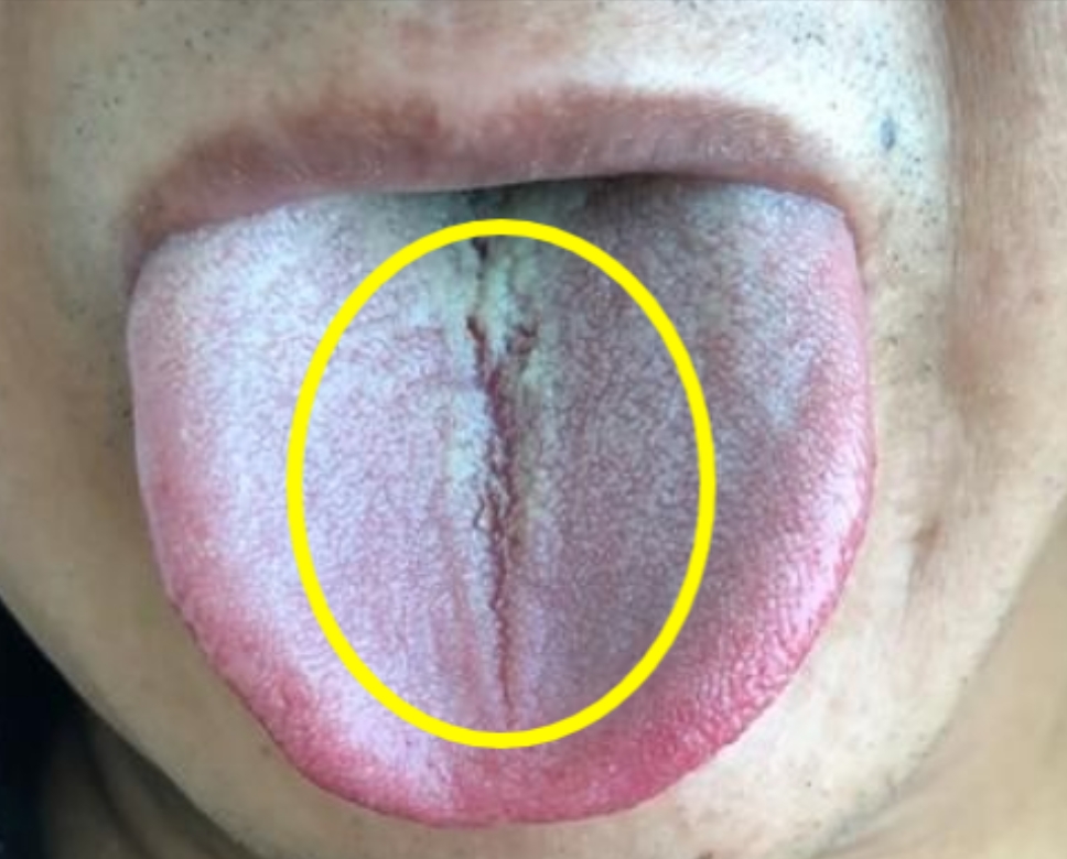 运化功能就会失调,营养物质无法正常转化,舌头也就失去了脾的滋养