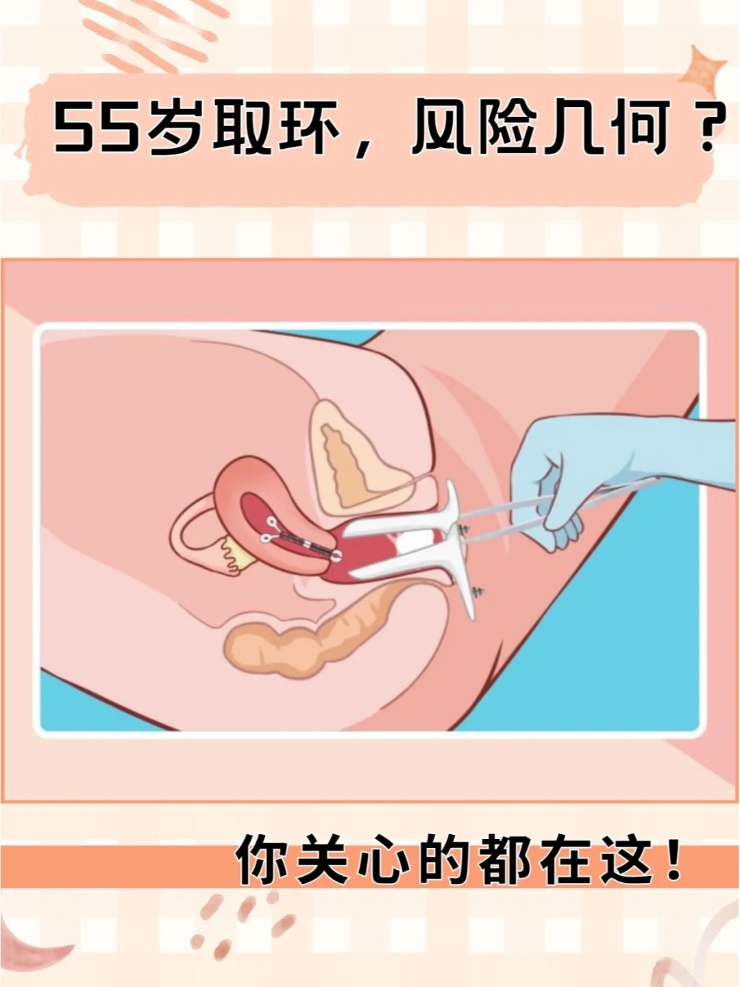 到了55岁,身体状况依然棒棒的,没有母体乐环好取吗女性取环取环过程图