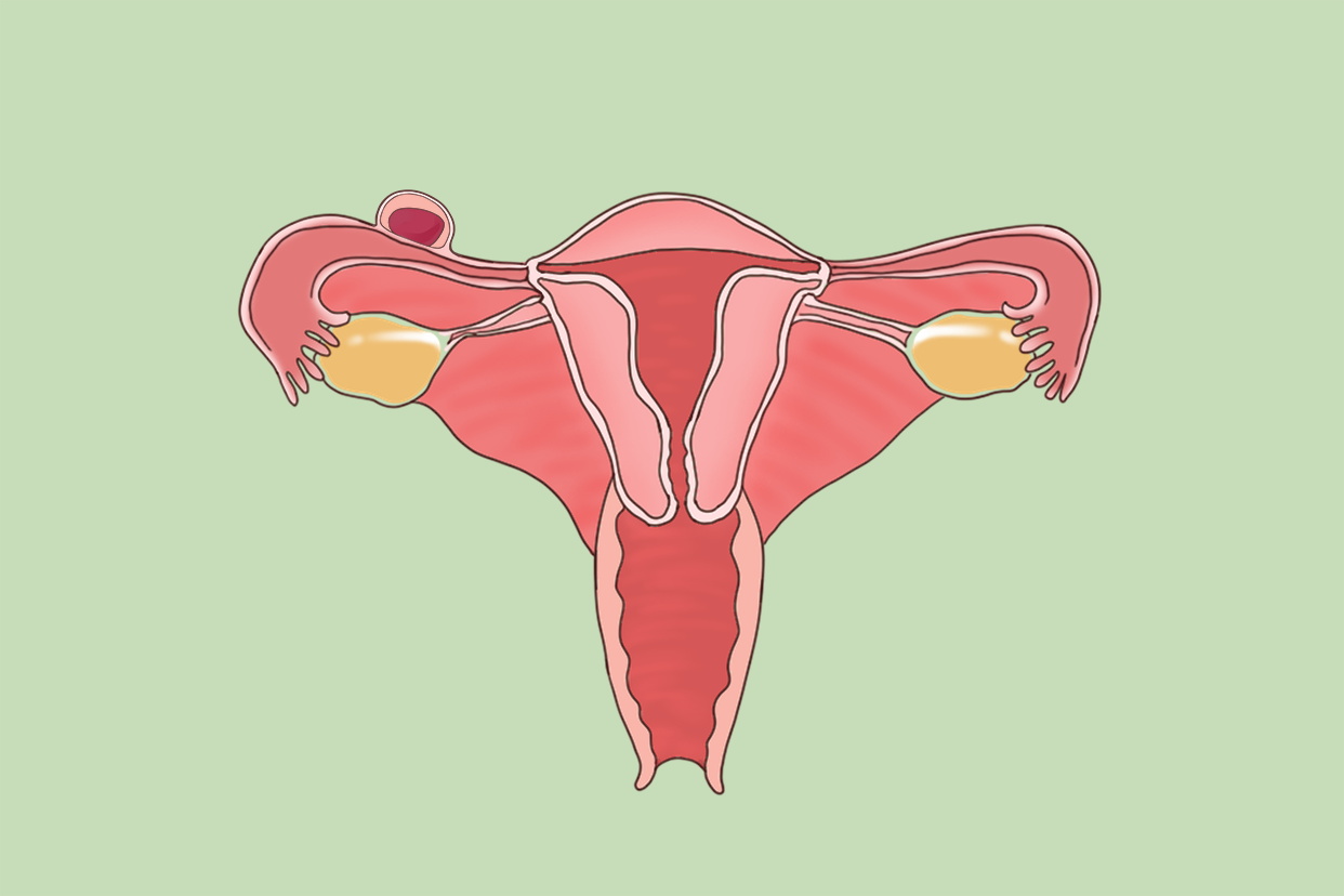 部分性葡萄胎的原因?