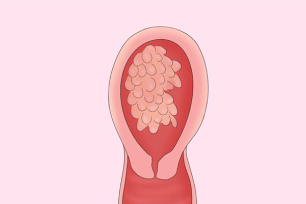 葡萄胎是一种妊娠滋养细胞疾病,其主要特征是胎盘绒毛组织异常增生