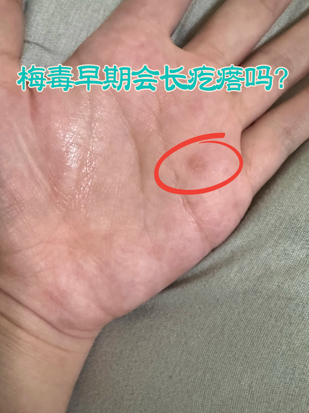 早期常见症状 硬下疳出现 质地特征 数量特点