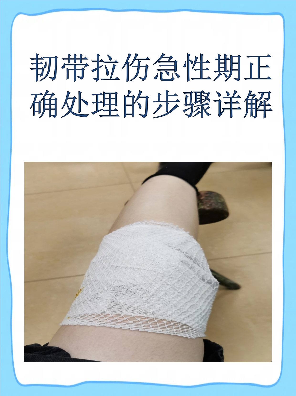 韧带拉伤急性期正确处理的步骤详解