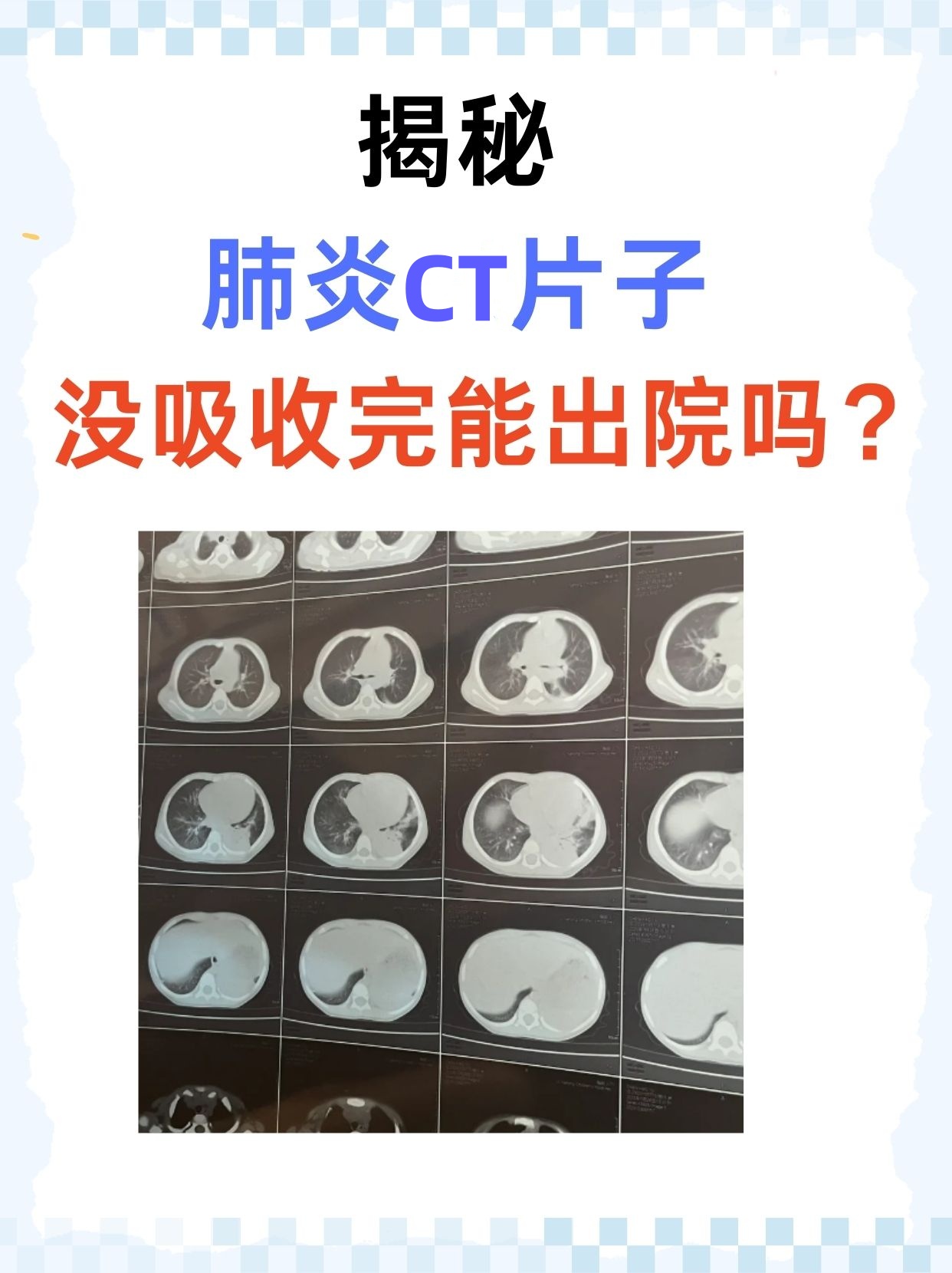 肺炎ct影像表现特点怎么看肺部ct片子图解新手看肺部ct片图解普通肺炎