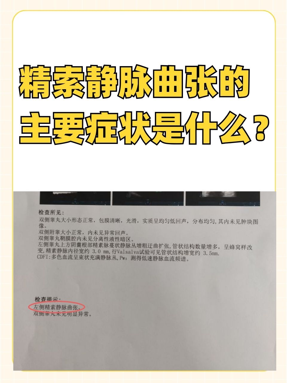 精索静脉曲张的主要症状是什么?