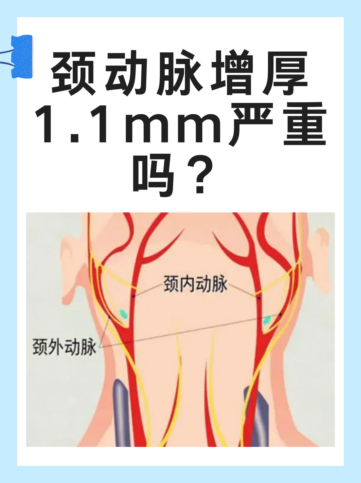 椎动脉v4段在什么位置图片