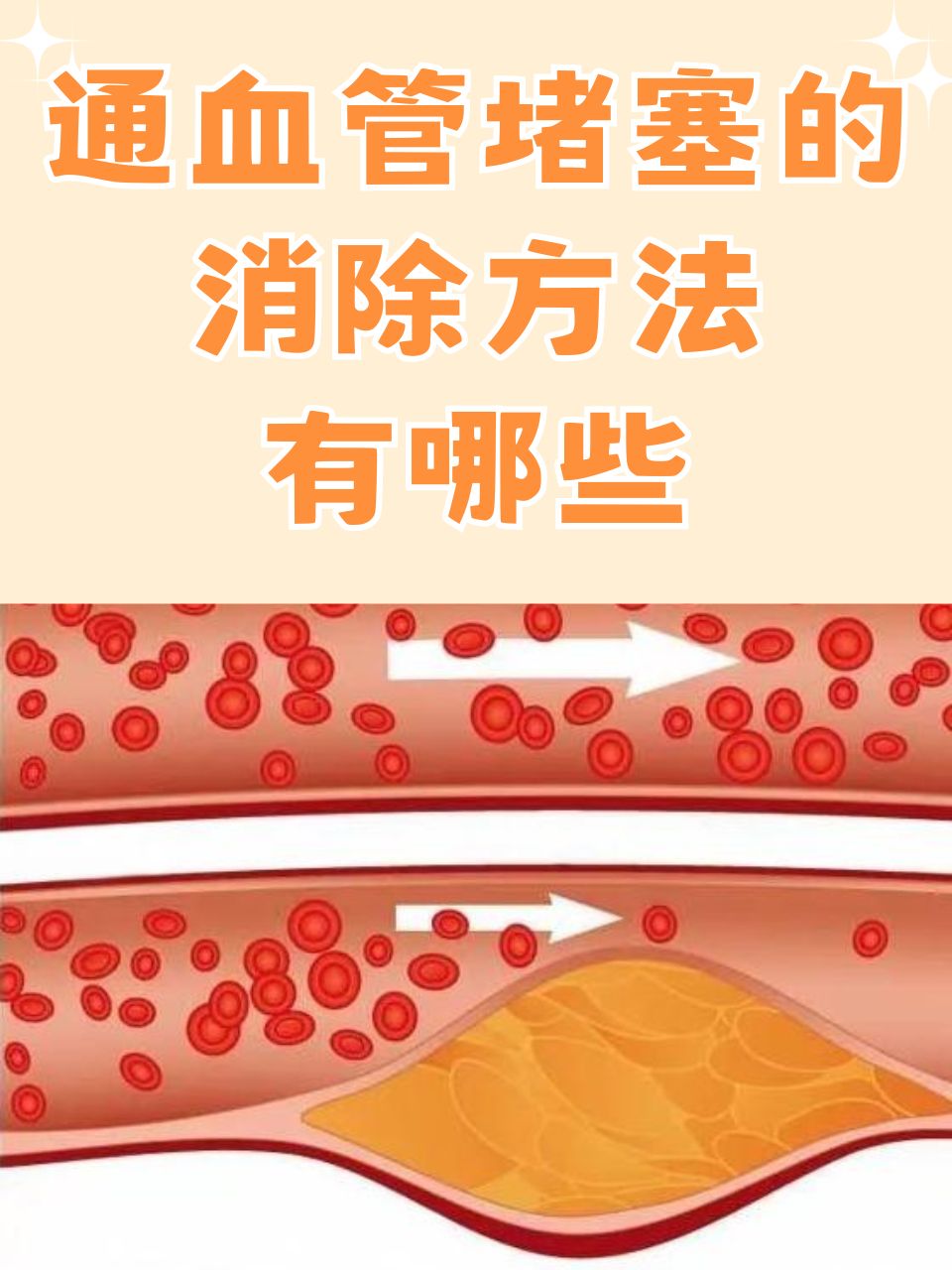 全身血管堵塞怎么办