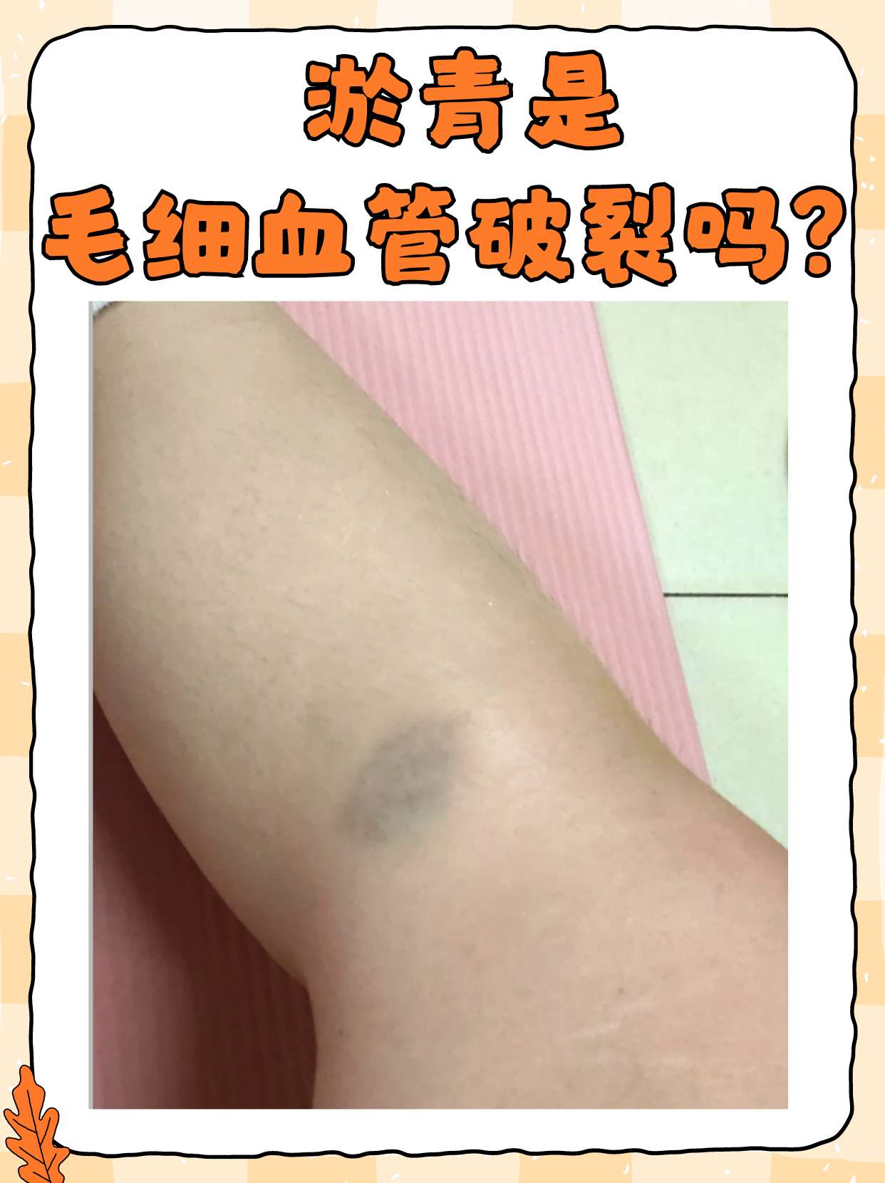 淤青是毛细血管破裂吗?