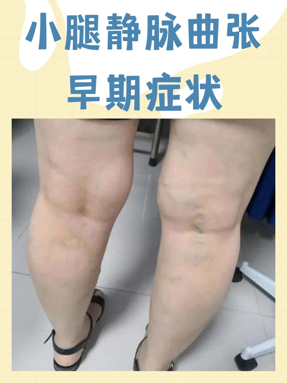 有一种常见病症——小腿静脉曲张,正悄然影响着许多人的生活.