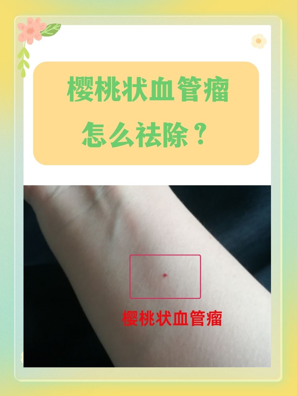 在皮肤疾病的治疗领域中,樱桃状血管瘤是一种较为常见的病变