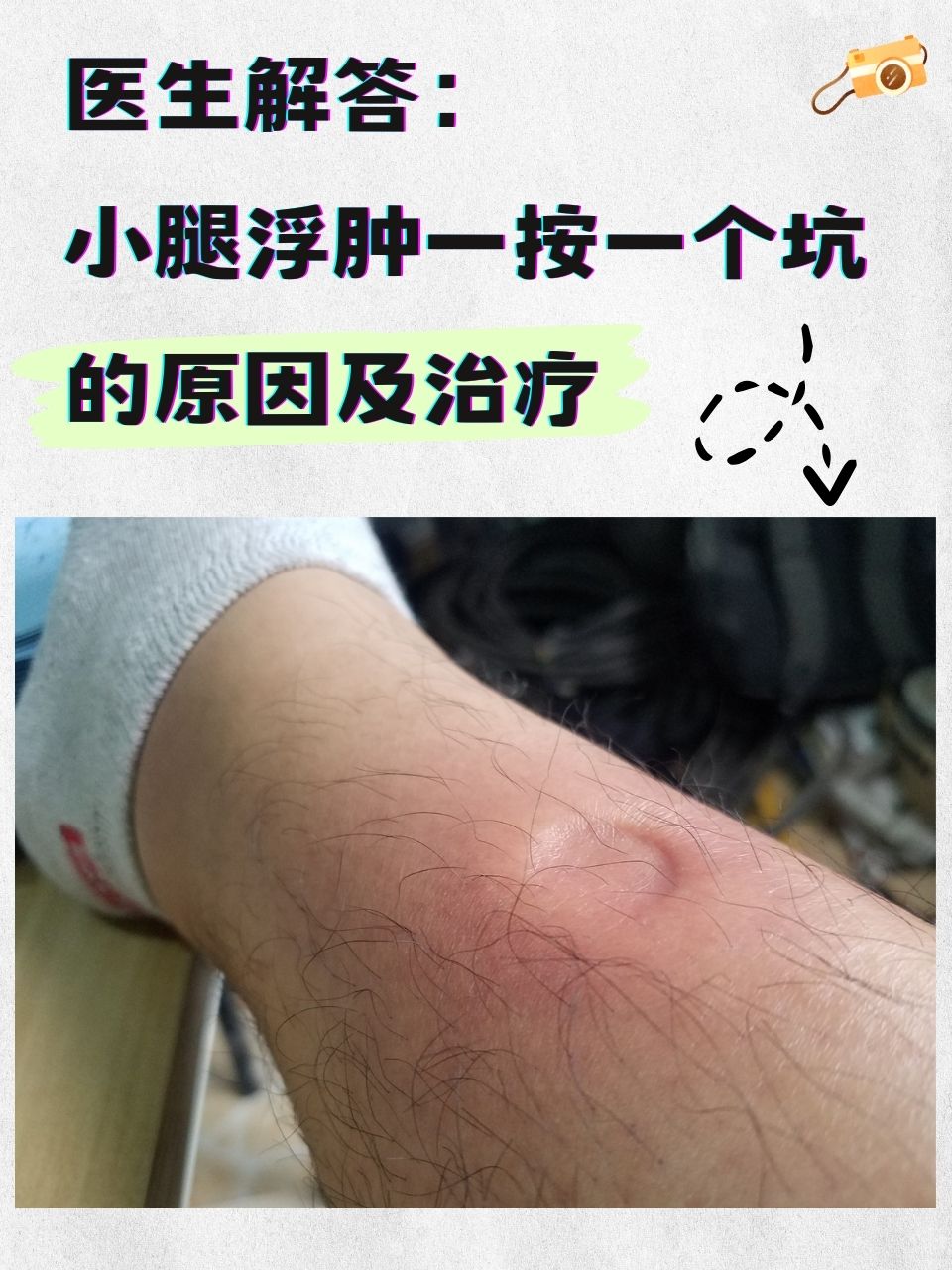医生解答:小腿浮肿一按一个坑的原因及治疗