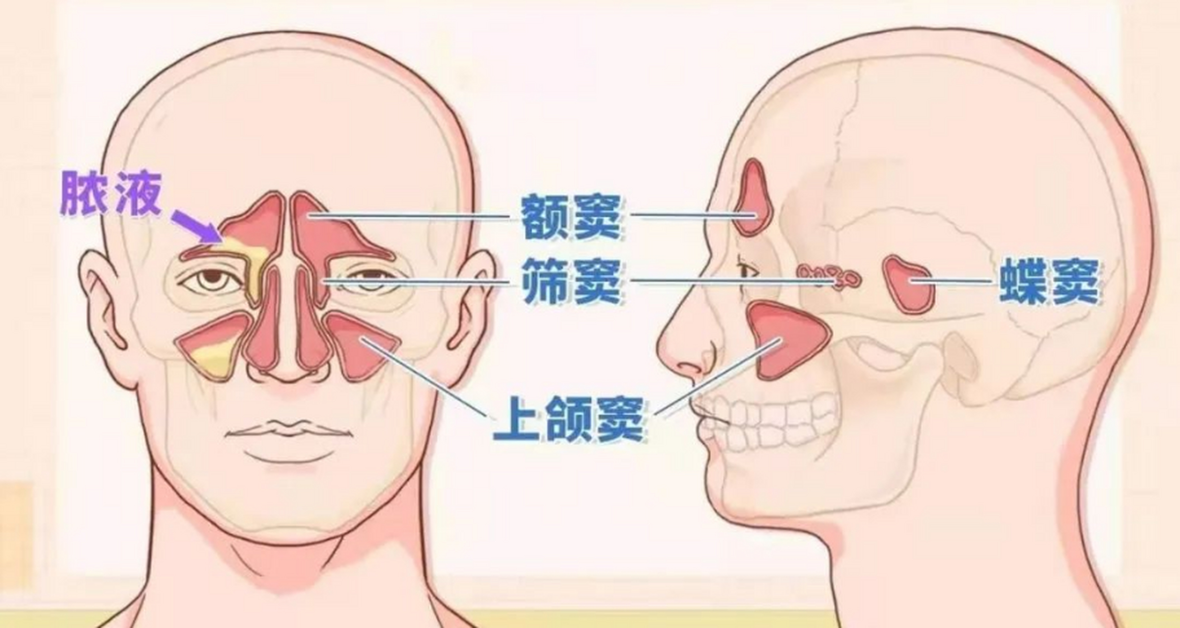 慢性鼻窦炎的4大特点,你中了吗?  1.流透明,白黏鼻涕  2.
