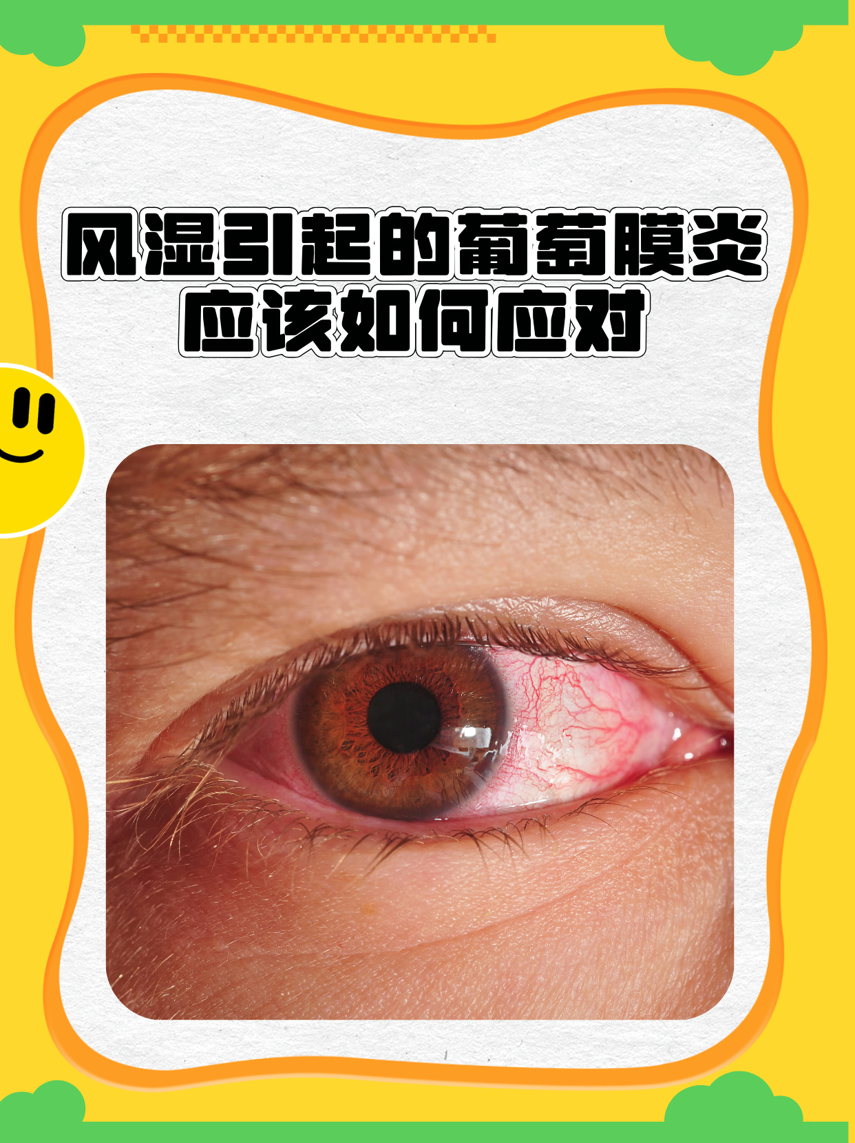 虹膜炎图片葡萄膜炎初期的照片巩膜炎前葡萄膜炎葡萄膜炎症状图片虹膜