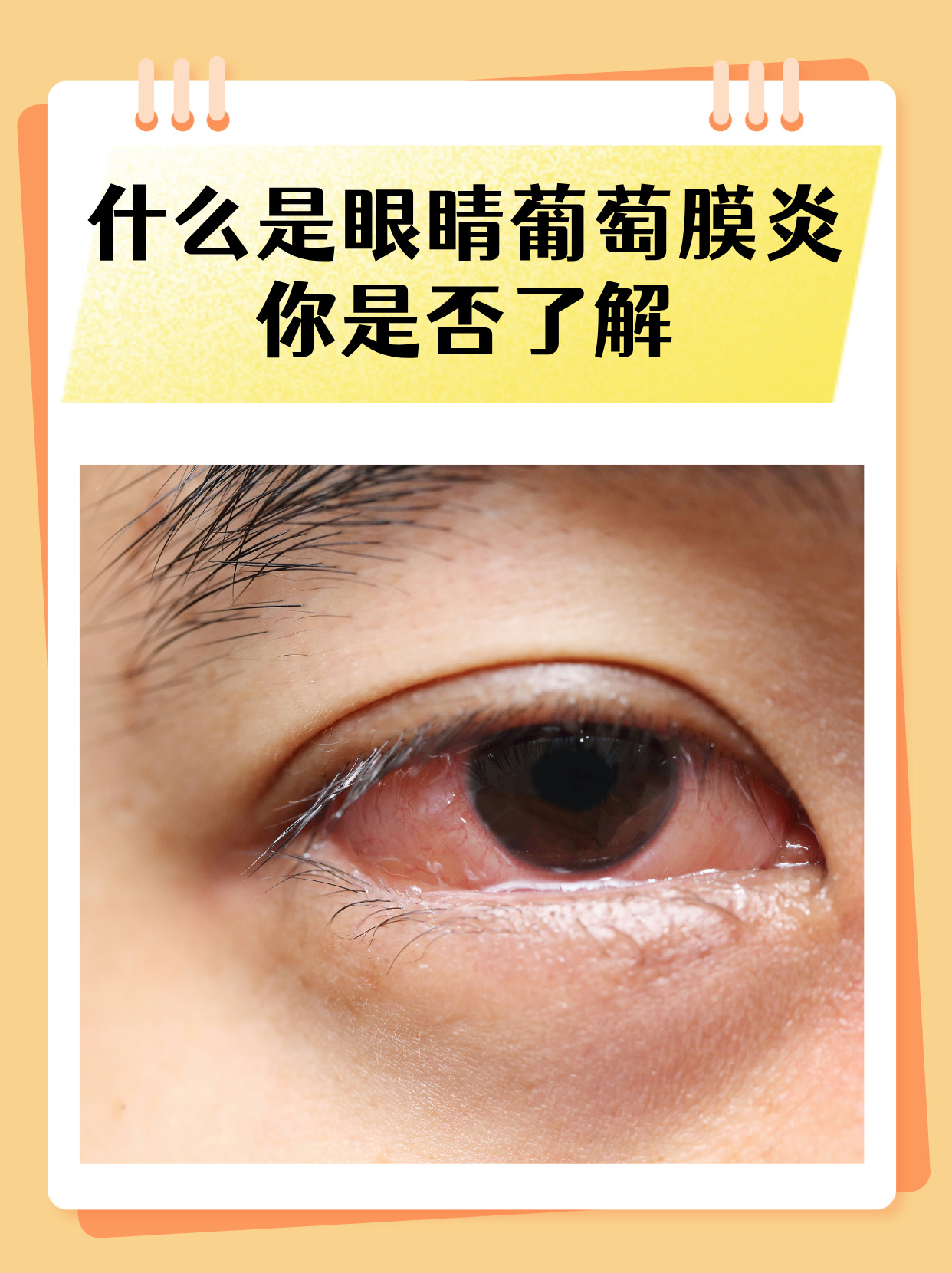 "什么是眼睛葡萄膜炎?你是否了解?