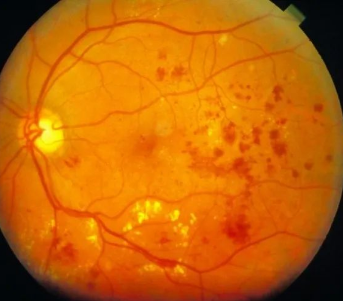 预防糖尿病眼底病变,中医推荐 3 类食物!